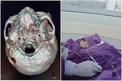 Clinical Analysis of the Treatment of Primary Trigeminal Neuralgia by Percutaneous Balloon Compression